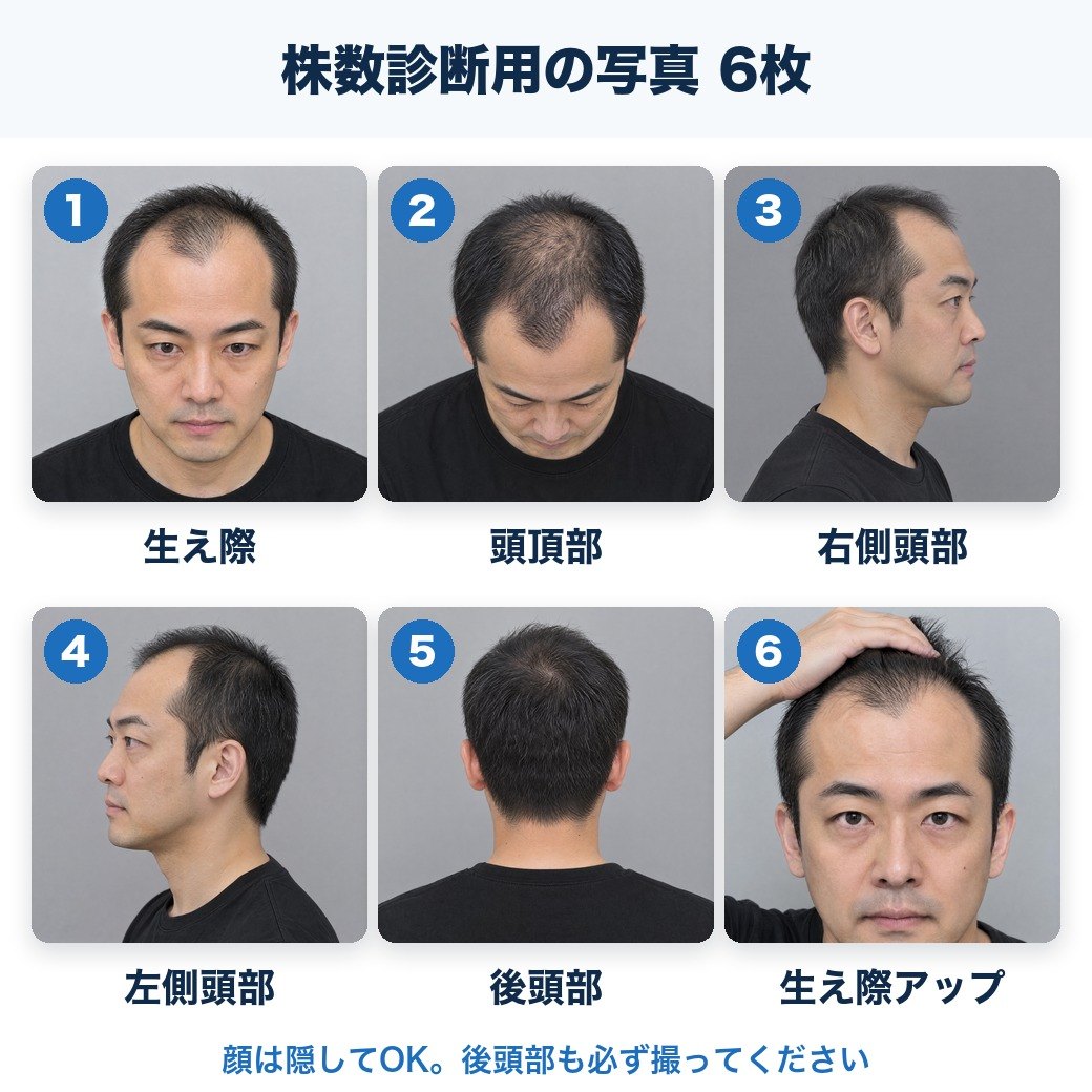 株数診断用の写真6枚の撮り方（生え際・頭頂部・右側頭部・左側頭部・後頭部・生え際アップ）